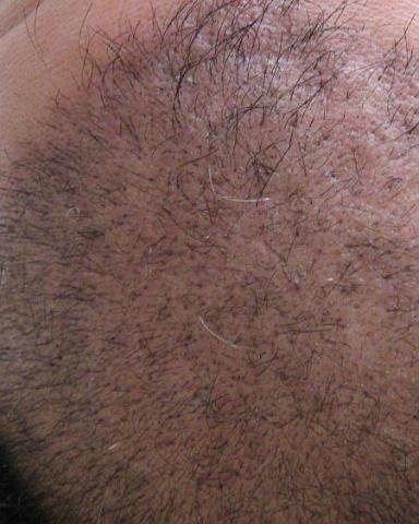 Ultra Refined Follicular Unit Grafting