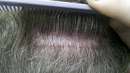 Hair Transplant Evolution