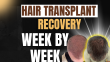 Hair Transplant Recovery Time: What to Expect Week by Week