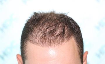 FUE Result - Front and crown with 3300 grafts – HDC Hair Clinic
