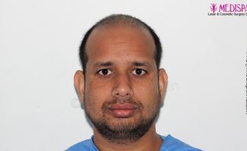 Dr. Suneet Soni - 4500 Grafts, Combine FUT + FUE + Beard Technique, NW-III