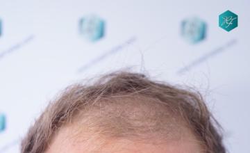 Dr. Rafael de Freitas - 3003 Grafts / 6479 Hairs - FUE