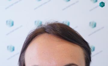 Dr. Rafael de Freitas - Woman - Congenit Frontomegalia – 2.375 Grafts / 6.390 Hairs