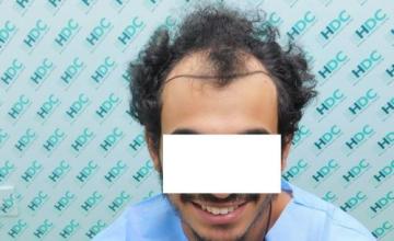 Dr. Christina at HDC clinic in Cyprus, 3070 FUE grafts curly hair result