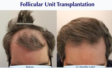 #BAM A Surprisingly Typical Hair Loss Pattern (3039 FUT grafts): Carlos K. Wesley, M.D. (NYC & LA)