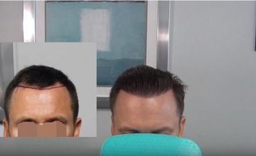 Hairlines: Not a "One Size Fits All" | Dr. Bloxham | 2,400 Grafts | Feller & Bloxham