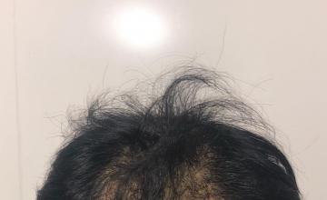FUE procedure by Dr Reddy - 3077 Grafts 12 months post-op