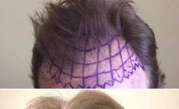 Dr. Louis Nader 8300 grafts FUE DHI