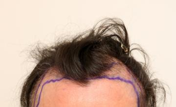 DR. ROBERT DORIN -  FUE :  Front/Temple Restoration