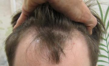 Dr. Timothy Carman- 3610 Total FU grafts; 1Yr Post Op Result