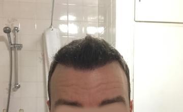 *VID/PICS* 4,000 Graft Hair Transplant / Feller &amp; Bloxham / Dr. Blake Bloxham (NY)
