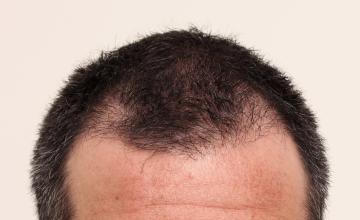 Dr. ROBERT DORIN NYC - 3346 FUE restoration (revision)