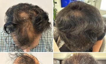 3.807 Grafts Dr. Bek Norwood VI