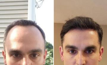 Norwood 3 Dr. Pradeep Sethi Eugenix 