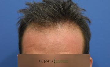 Dr Timothy Carman 1570 FU Grafts; 17 month FU