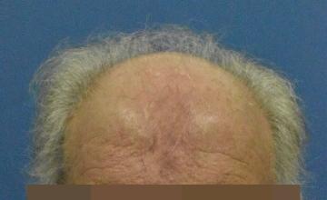 Dr Timothy Carman ABHRS FISHRS 2291 FU Grafts