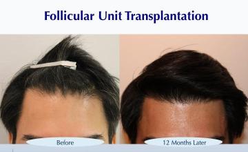 #BAM Stronger, Healthier Hairline (2814 FUT grafts): Carlos K. Wesley, M.D. (NYC & LA)