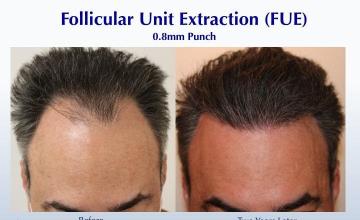 #BAM Hairline Objectives Met (2527 grafts): Carlos K. Wesley, M.D. (NYC & LA)
