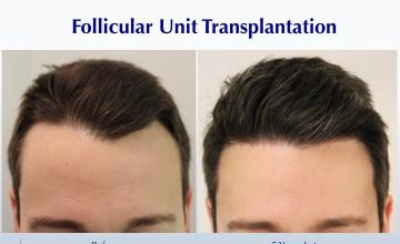 #BAM Hairline Symmetry (1404 FUT grafts): Carlos K. Wesley, M.D. (NYC & LA)