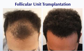 #BAM Fall Back? Hair Forward! (2312 FUT grafts): Carlos K. Wesley, M.D. (NYC & LA)