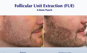 Formation of Beard  (474 FUE beard grafts): Carlos K. Wesley, M.D. (NYC & LA)