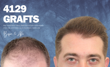 CHOIEXPERT- HAIR RESTORATION RESULTS