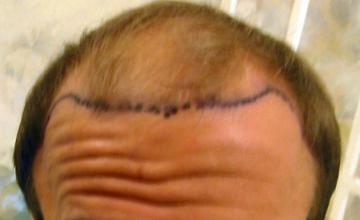 Dr. Timothy Carman- 3757 Total FU grafts; One year Post Op Result