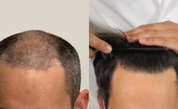 Dr. Espinosa Custodio - 2965 grafts - FUE Hair Transplant