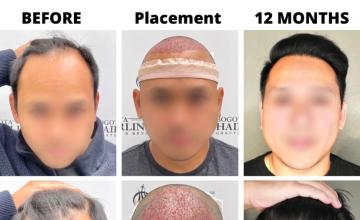 Bogota Hairlines -  3093 Grafts - Dr Sergio Camacho (Harsh Light)