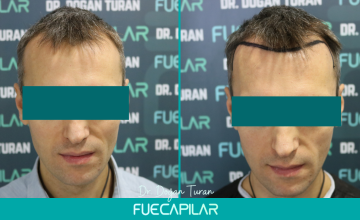  Dr. Turan - FUECAPILAR Clinic, NW III , 3418 grafts
