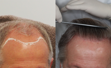 Dr. Espinosa Custodio - 5,179 grafts - FUE Hair Transplant