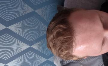 Hair Transplant By Dr Manish Mittal (Dr Mani) 2200 grafts - Post 18 months