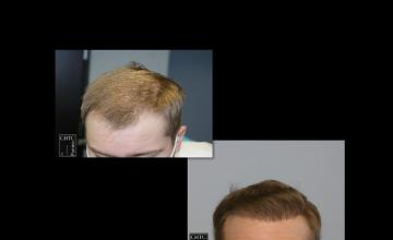 PANINE, MD | Chicago Hair Transplant Clinic | 2,500 Graft FUE Hair Transplant At 2 Weeks and 1 Year Post-Op