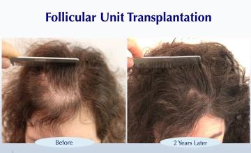 #BAM Female Frontal Hair Fullness (1432 FUT grafts): Carlos K. Wesley, M.D. (NYC & LA)