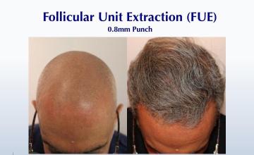 #BAM Salt 'n Pepper FUE (2840 FUE grafts): Carlos K. Wesley, M.D. (NYC & LA)