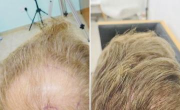 Crown Restoration 