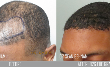Frontal view - before and after