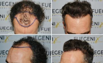 Before and After front and side view 