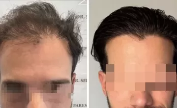 Before and After