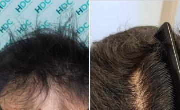 Hairline density