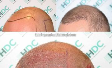 Hair transplantation surgery before and after pictures
