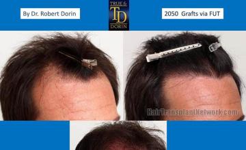 Hair transplantation surgery before and after images