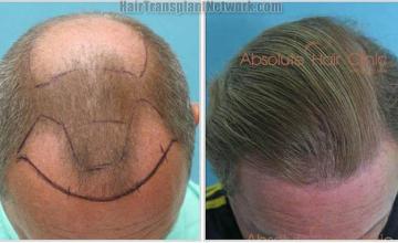 Hair transplantation procedure before and after photos