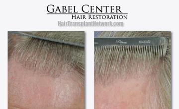 Hair transplant surgery before and after images