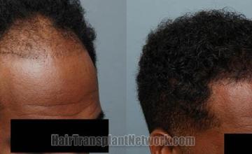 Right view before and after 