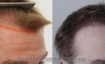 Hair transplantation surgery before and after pictures