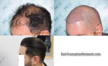  before and after photos