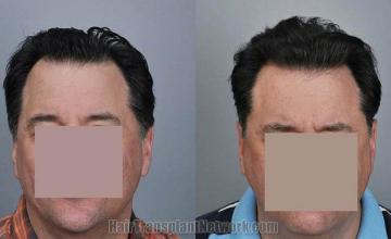 Before and after hair transplantation result photographs