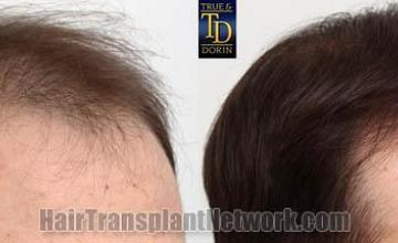 Hair transplantation surgery before and after images
