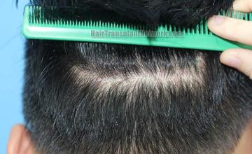 Hair replacement surgery before and after images